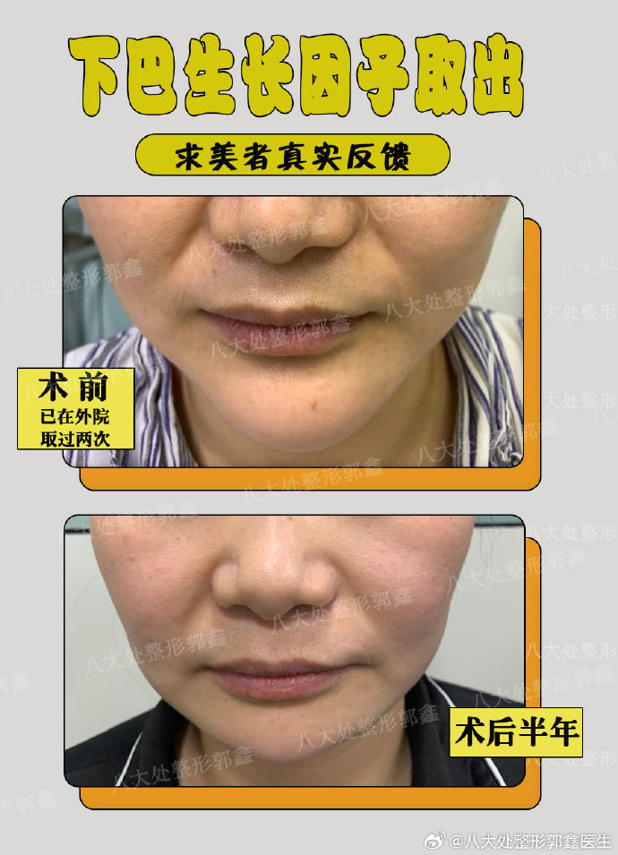郭鑫取异物案例